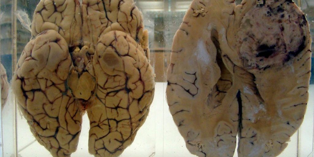 Новейшие методы лечения рака головного мозга - Медкор